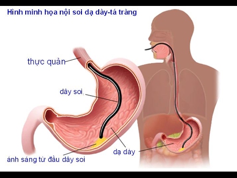 Hình minh họa nội soi dạ dày, tá tràng.