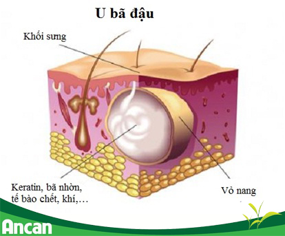 Hình ảnh cấu tạo khối u bã đậu