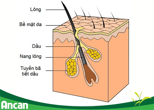 Tuyến bã không thoát được dần tích tụ thành u bã đậu